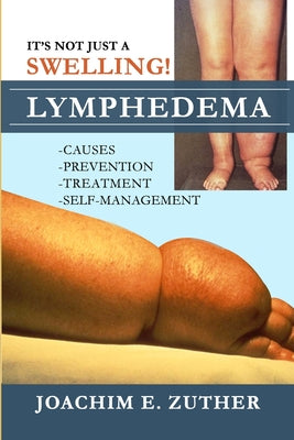 Cover Image for It's Not Just a Swelling! Lymphedema: Causes, Prevention, Treatment, Self-Management -- Joachim Zuther, Paperback